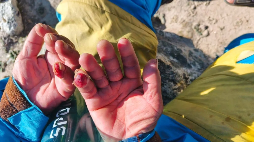 Abandoned on Everest: The Miraculous Return of Dawa Sherpa Exposes a Dark Industry Secret 3 dawa-shepra-recovery